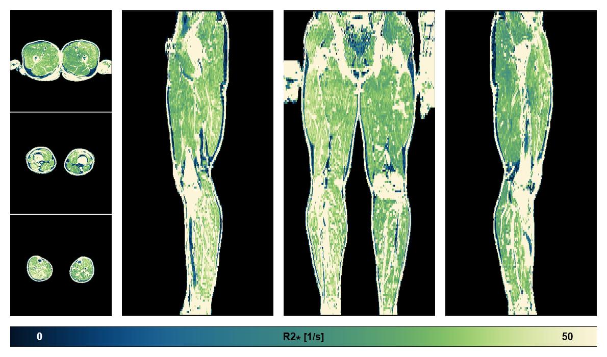 The R2 star relaxation time of the lower extremity obtained from the dixon reconstruction for muscle water fat quantification.