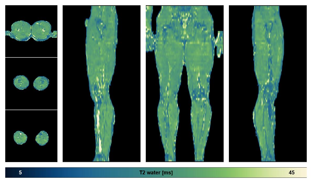 The water only T2 relaxation time of the lower extremity obtained from multi echo spin echo t2 mapping with EPG based reconstruction.