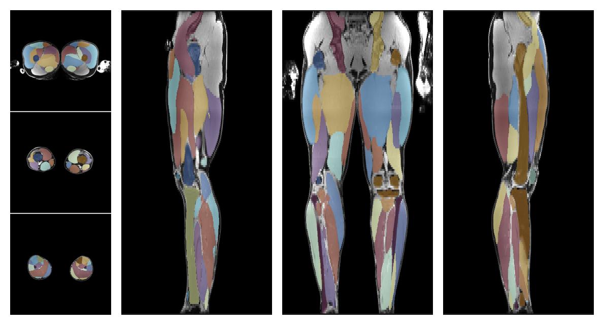 Overlay of automated muscle segmentation labels on dixon water image.