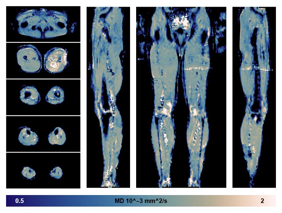 IVIM corrected whole leg muscle mean diffusivity obtained from diffusion tensor imaging.