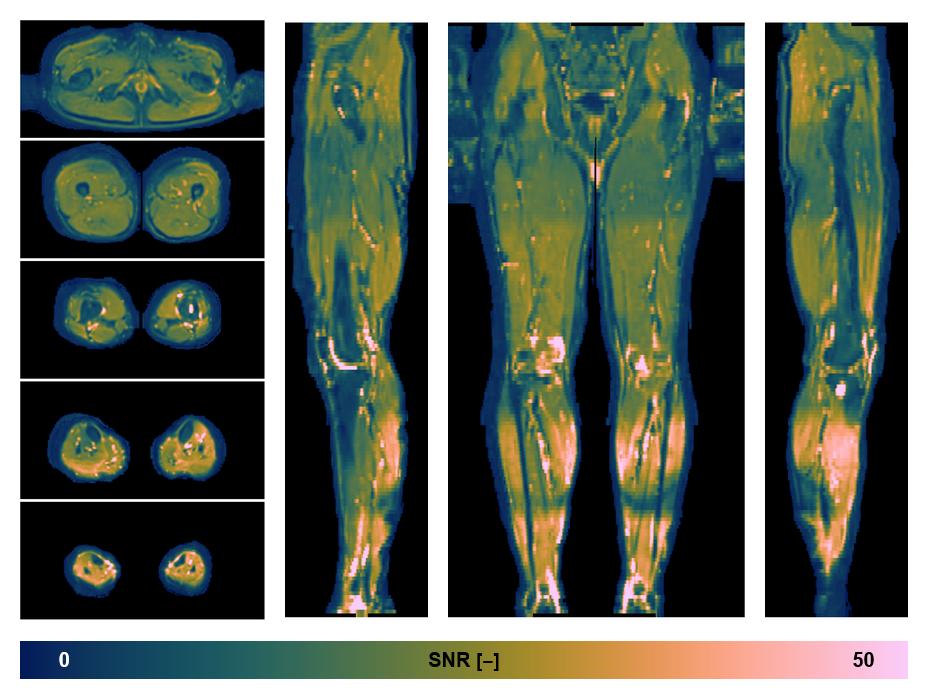 SNR distribution of the unweighted diffusion data.