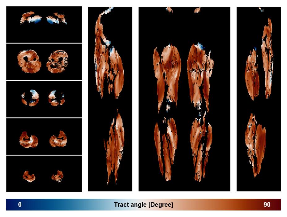Muscle fiber tract angle map based on whole leg DTI based fiber tractography.