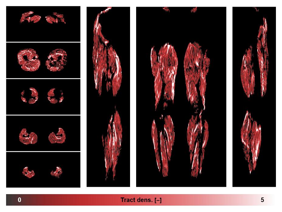 Muscle fiber tract density map based on whole leg DTI based fiber tractography.