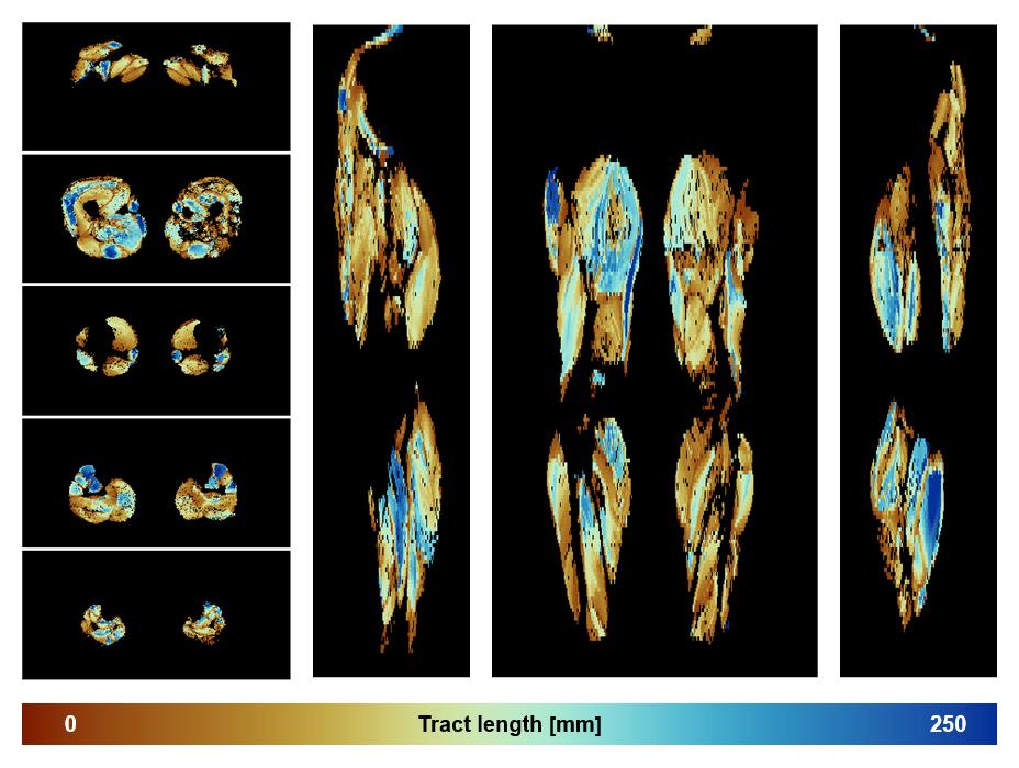 Muscle fiber tract length map based on whole leg DTI based fiber tractography.