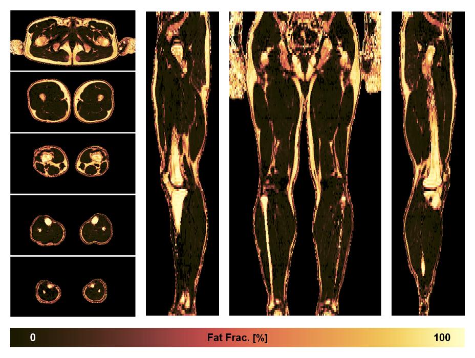The fat fraction of the lower extremity obtained from the dixon reconstruction for muscle water fat quantification.