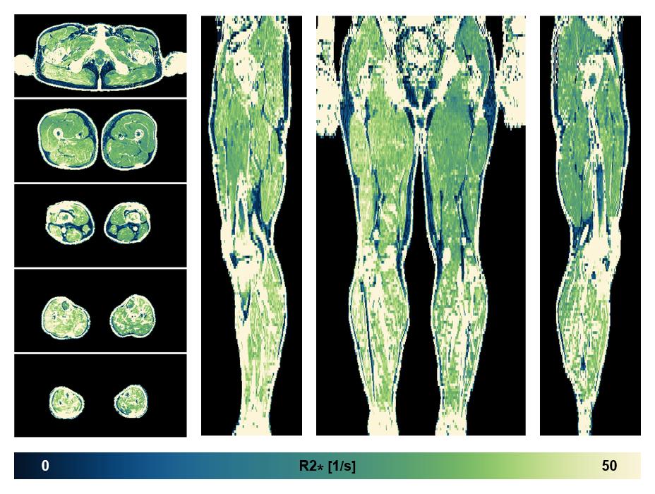 The R2 star relaxation time of the lower extremity obtained from the dixon reconstruction for muscle water fat quantification.