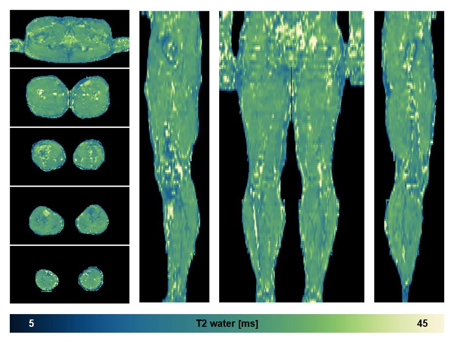 The water only T2 relaxation time of the lower extremity obtained from multi echo spin echo t2 mapping with EPG based reconstruction.
