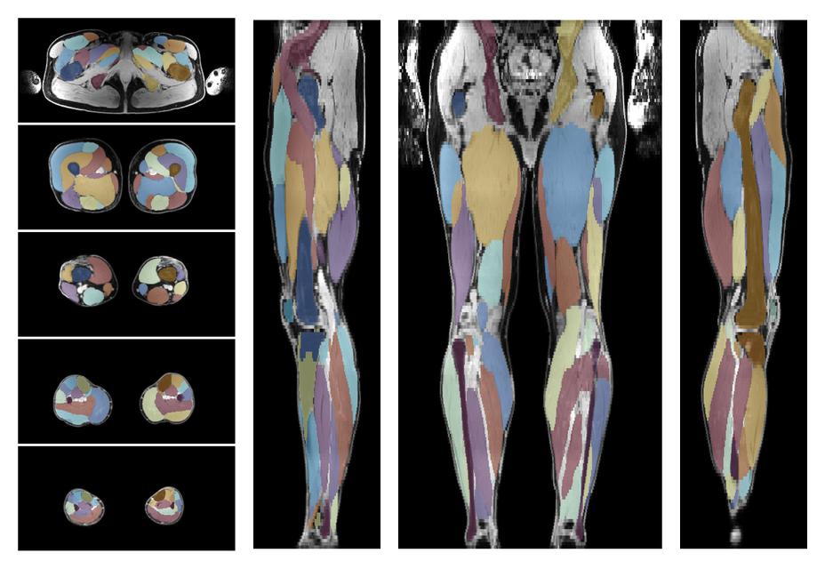Overlay of automated muscle segmentation labels on dixon water image.