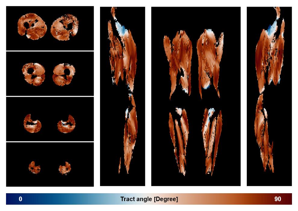 Muscle fiber tract angle map based on whole leg DTI based fiber tractography.