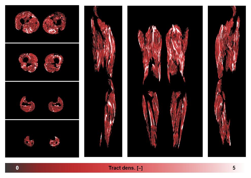 Muscle fiber tract density map based on whole leg DTI based fiber tractography.
