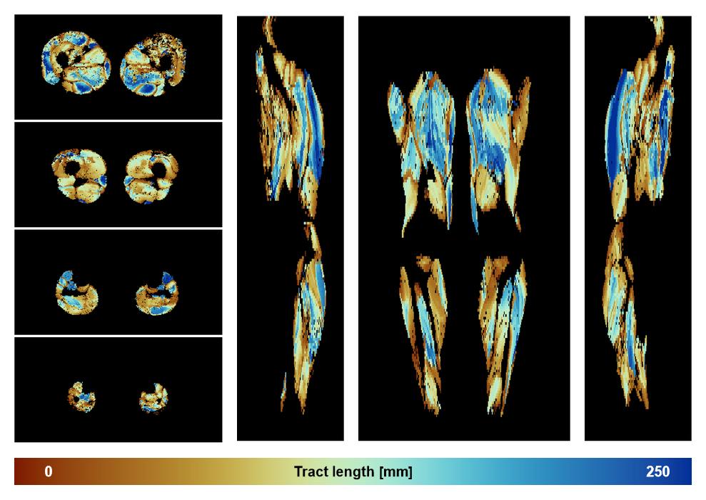 Muscle fiber tract length map based on whole leg DTI based fiber tractography.