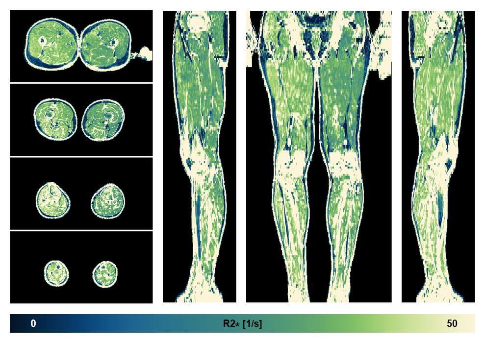 The R2 star relaxation time of the lower extremity obtained from the dixon reconstruction for muscle water fat quantification.