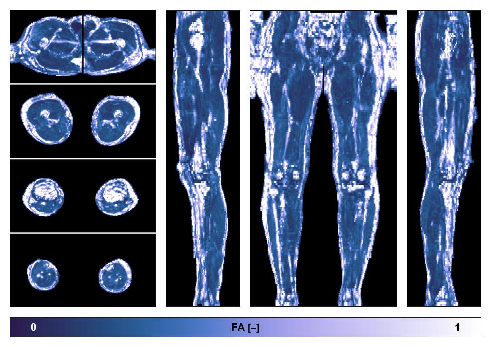 IVIM corrected whole leg muscle fractional anisotropy obtained from diffusion tensor imaging.