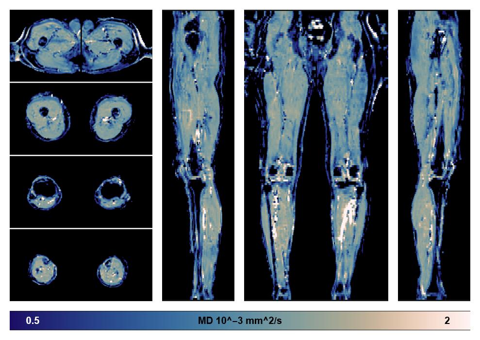 IVIM corrected whole leg muscle mean diffusivity obtained from diffusion tensor imaging.