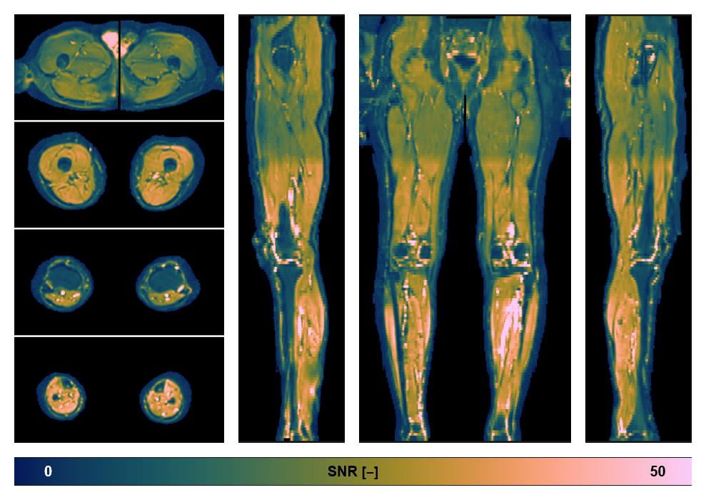 SNR distribution of the unweighted diffusion data.