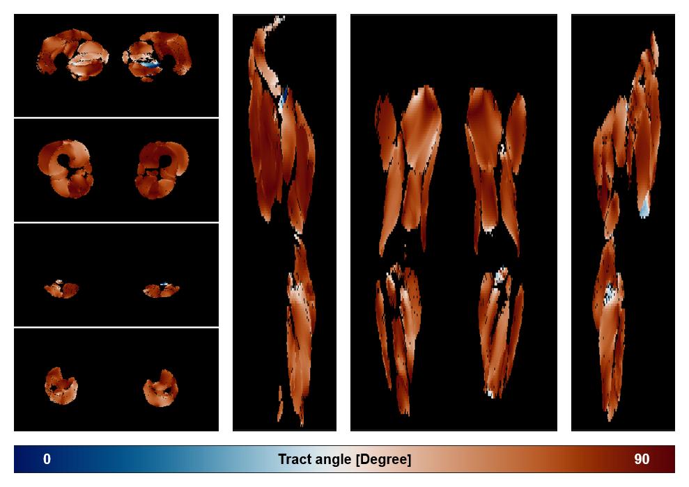 Muscle fiber tract angle map based on whole leg DTI based fiber tractography.