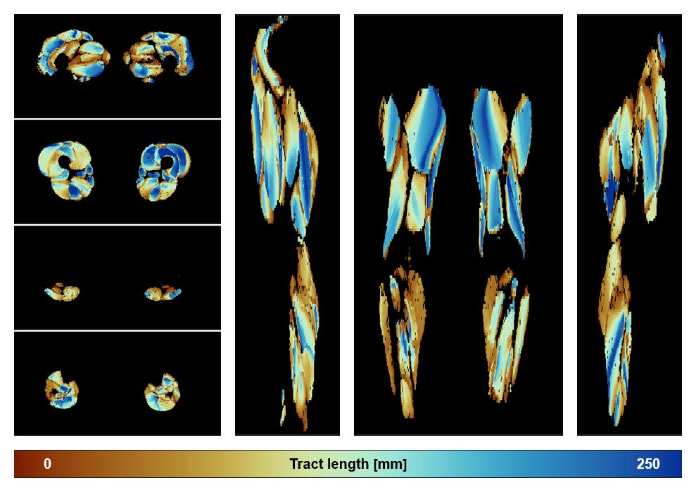 Muscle fiber tract length map based on whole leg DTI based fiber tractography.