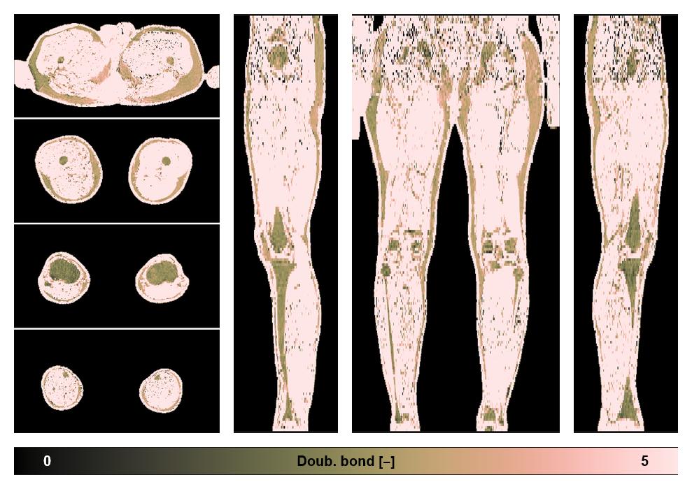 Number of double bonds in subcutanious fat.