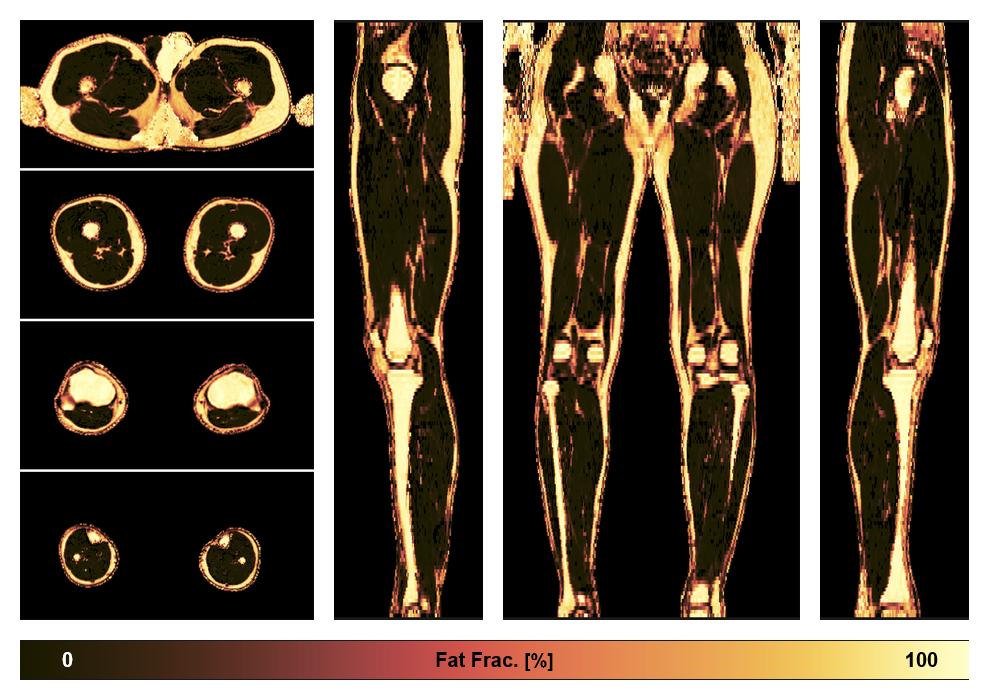 The fat fraction of the lower extremity obtained from the dixon reconstruction for muscle water fat quantification.