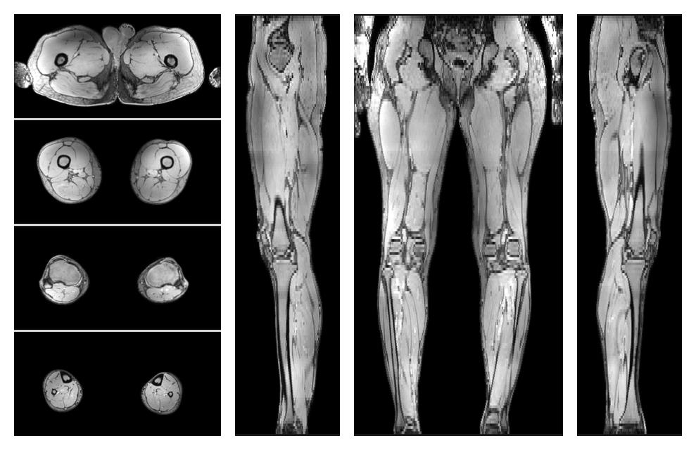 The out-phase image of the dixon reconstruction for water fat quantification.
