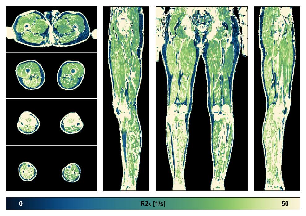 The R2 star relaxation time of the lower extremity obtained from the dixon reconstruction for muscle water fat quantification.