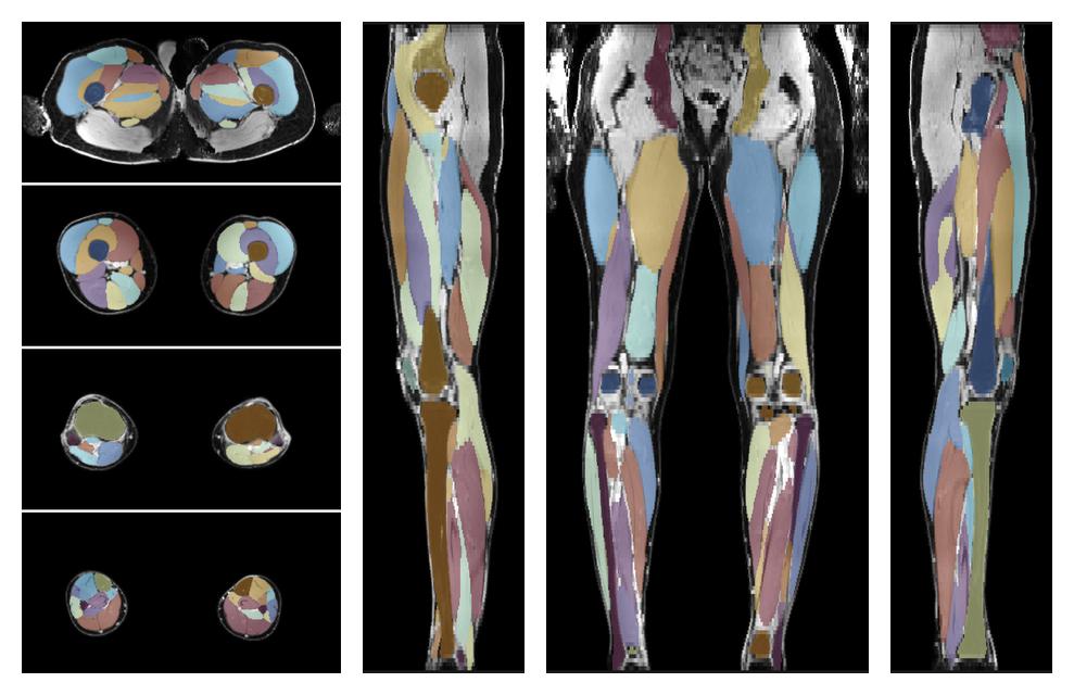 Overlay of automated muscle segmentation labels on dixon water image.