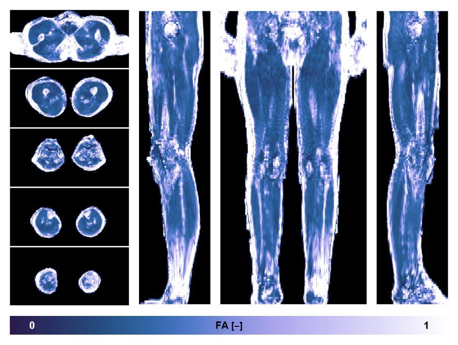 IVIM corrected whole leg muscle fractional anisotropy obtained from diffusion tensor imaging.