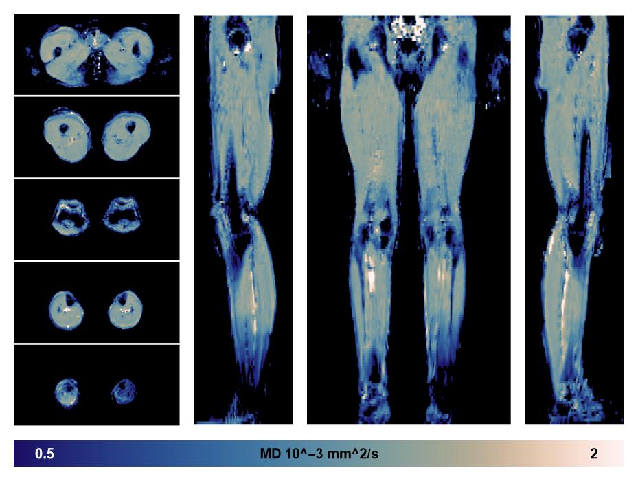 IVIM corrected whole leg muscle mean diffusivity obtained from diffusion tensor imaging.