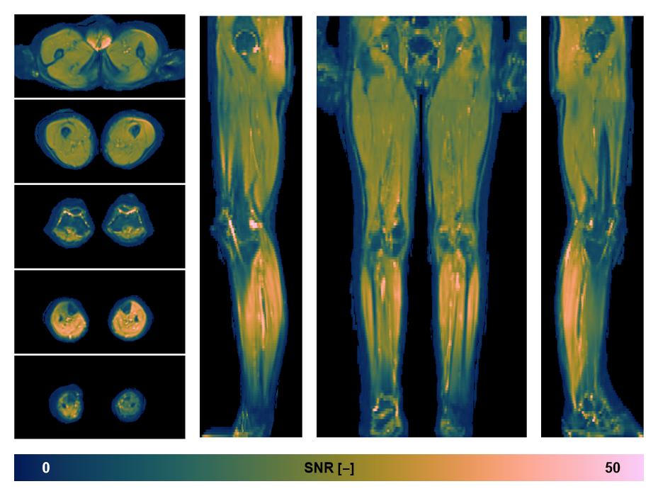 SNR distribution of the unweighted diffusion data.