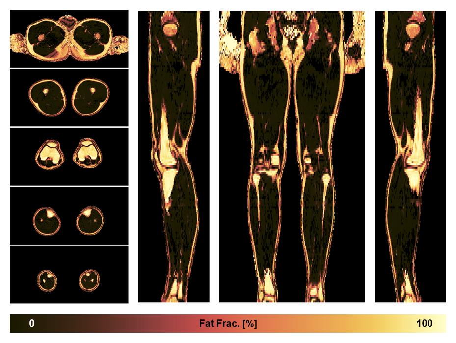 The fat fraction of the lower extremity obtained from the dixon reconstruction for muscle water fat quantification.