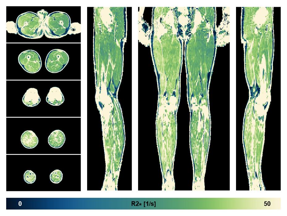 The R2 star relaxation time of the lower extremity obtained from the dixon reconstruction for muscle water fat quantification.