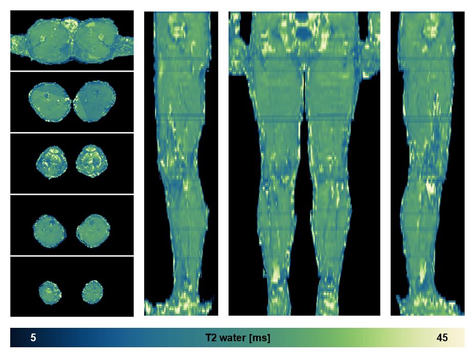 The water only T2 relaxation time of the lower extremity obtained from multi echo spin echo t2 mapping with EPG based reconstruction.