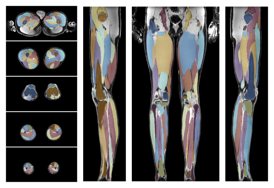 Overlay of automated muscle segmentation labels on dixon water image.