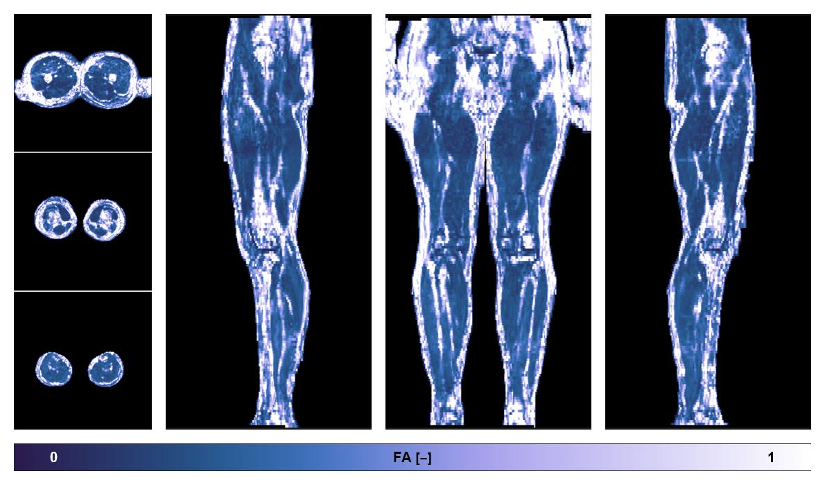 IVIM corrected whole leg muscle fractional anisotropy obtained from diffusion tensor imaging.