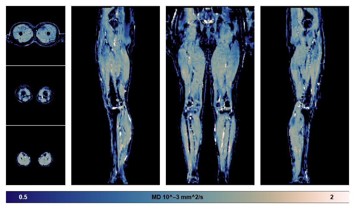IVIM corrected whole leg muscle mean diffusivity obtained from diffusion tensor imaging.