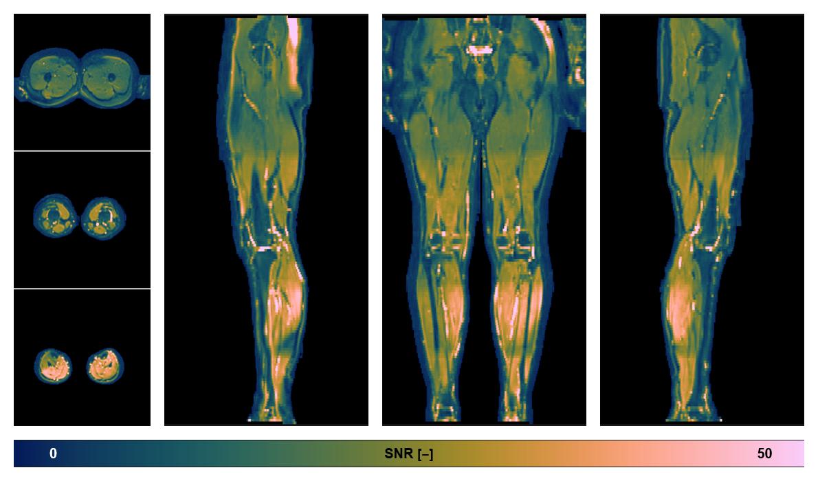 SNR distribution of the unweighted diffusion data.