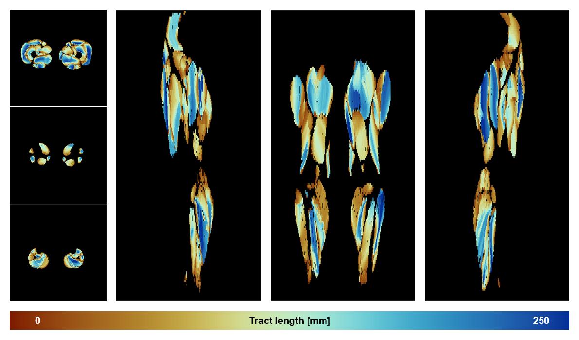 Muscle fiber tract length map based on whole leg DTI based fiber tractography.