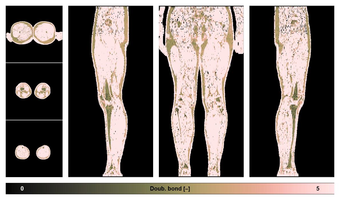 Number of double bonds in subcutanious fat.