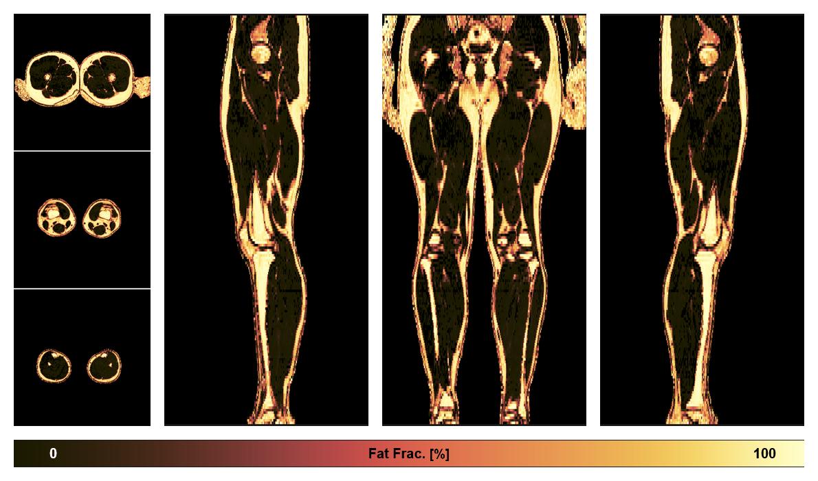The fat fraction of the lower extremity obtained from the dixon reconstruction for muscle water fat quantification.