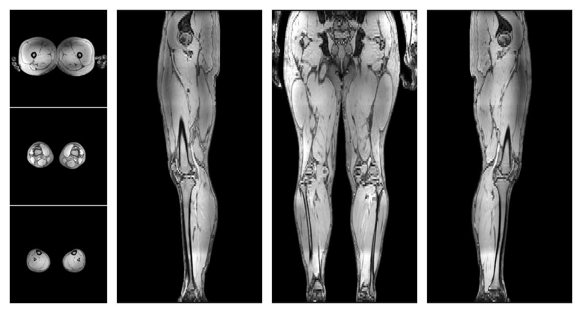 The out-phase image of the dixon reconstruction for water fat quantification.