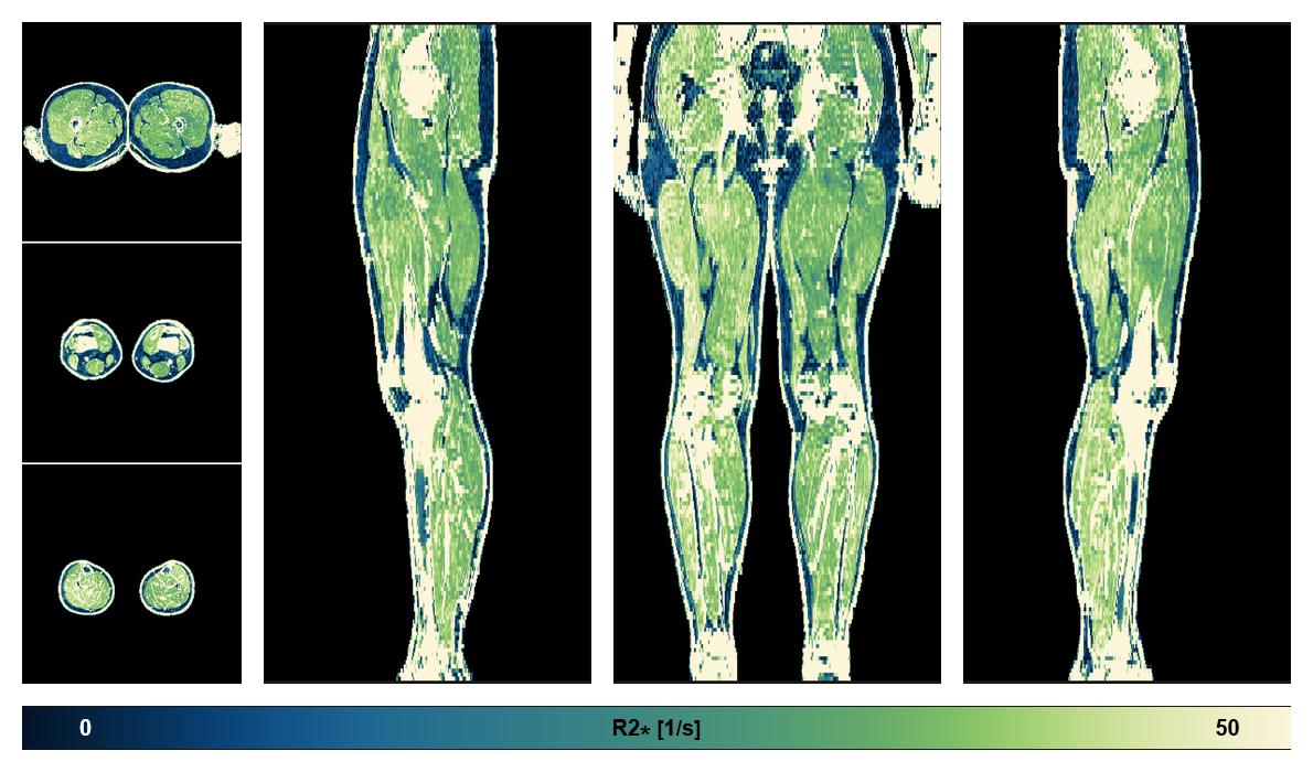 The R2 star relaxation time of the lower extremity obtained from the dixon reconstruction for muscle water fat quantification.