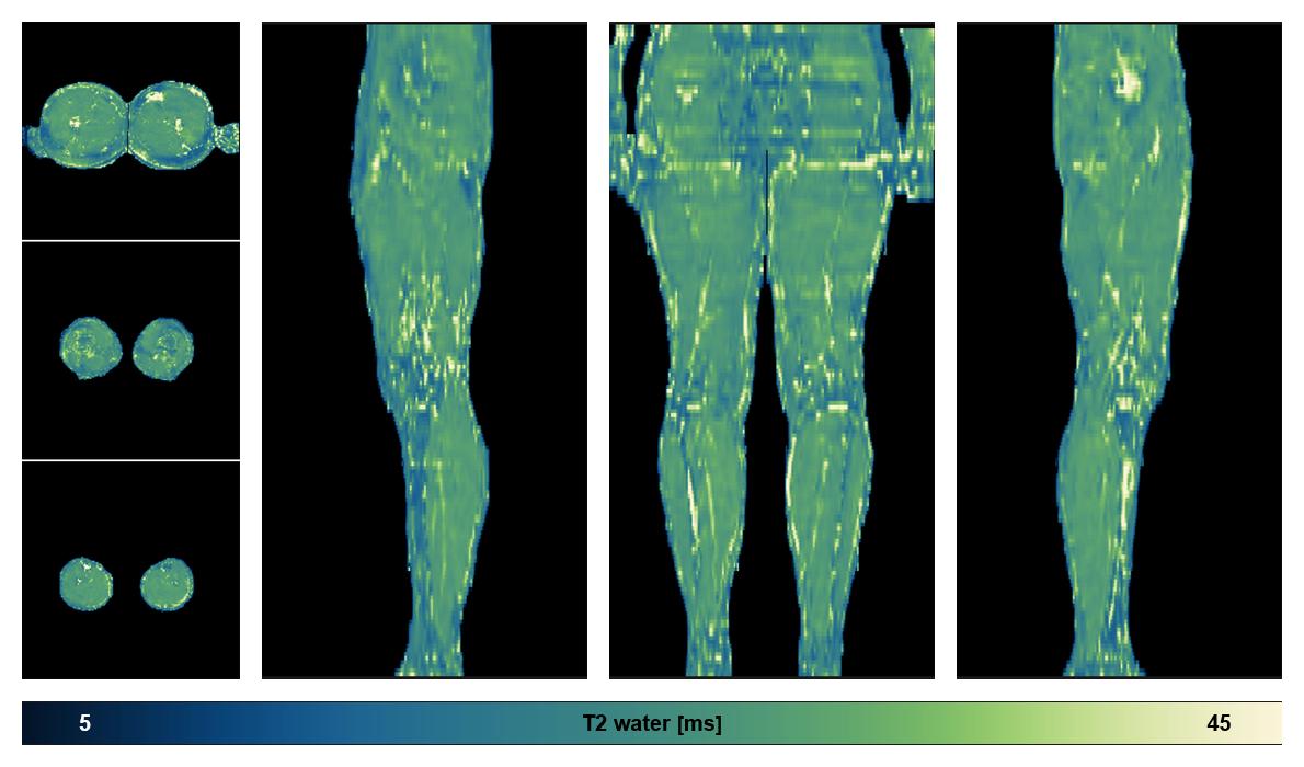 The water only T2 relaxation time of the lower extremity obtained from multi echo spin echo t2 mapping with EPG based reconstruction.