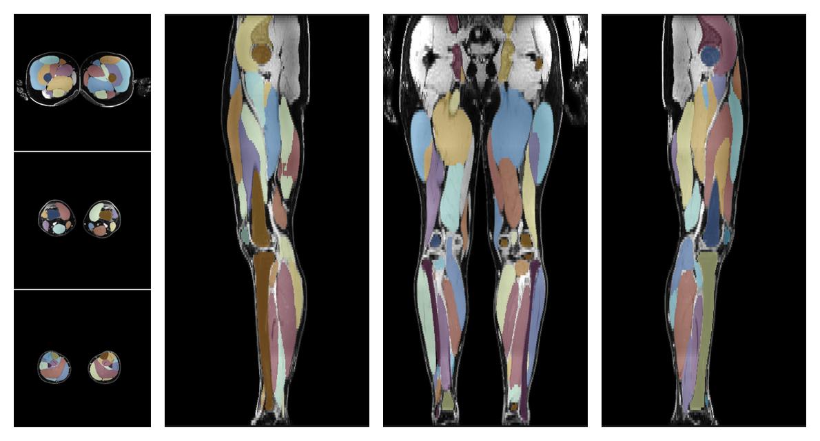 Overlay of automated muscle segmentation labels on dixon water image.
