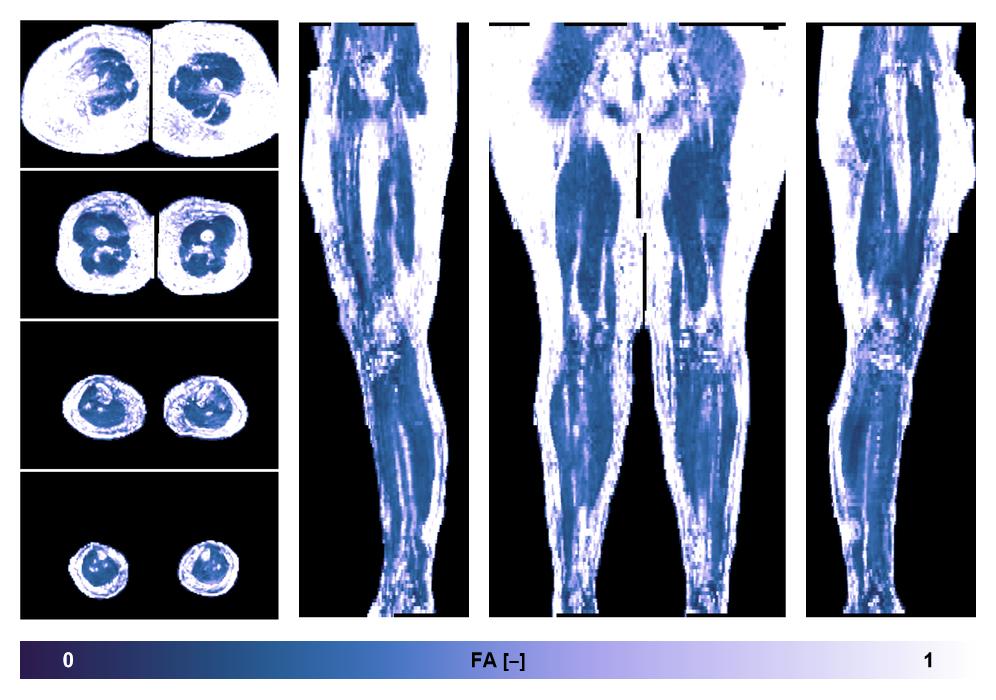 IVIM corrected whole leg muscle fractional anisotropy obtained from diffusion tensor imaging.