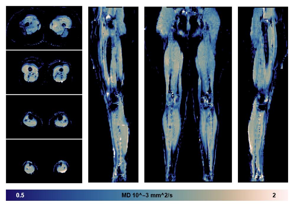 IVIM corrected whole leg muscle mean diffusivity obtained from diffusion tensor imaging.