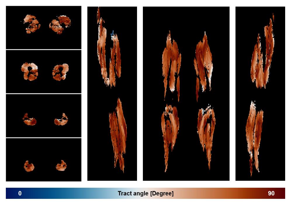 Muscle fiber tract angle map based on whole leg DTI based fiber tractography.