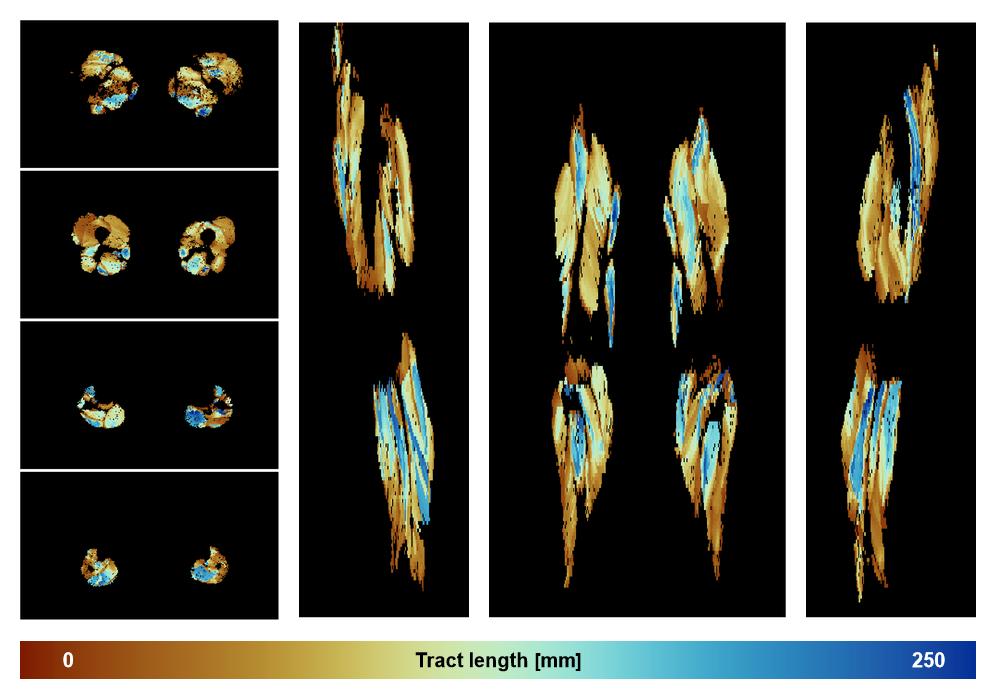 Muscle fiber tract length map based on whole leg DTI based fiber tractography.