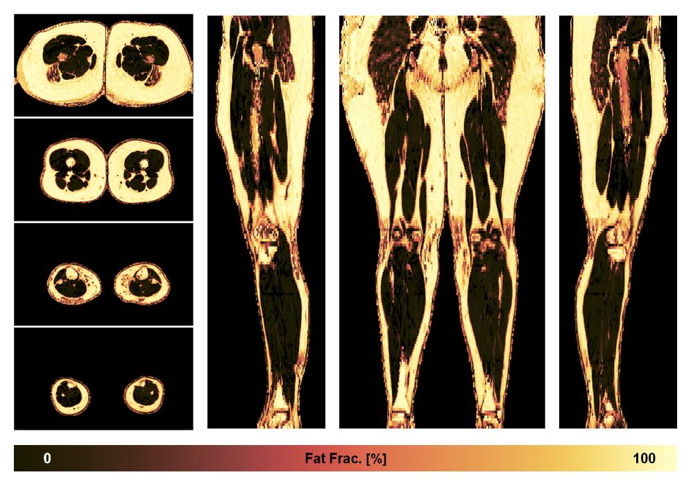 The fat fraction of the lower extremity obtained from the dixon reconstruction for muscle water fat quantification.