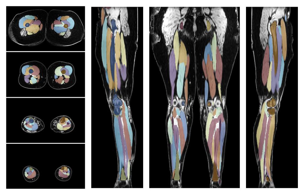 Overlay of automated muscle segmentation labels on dixon water image.