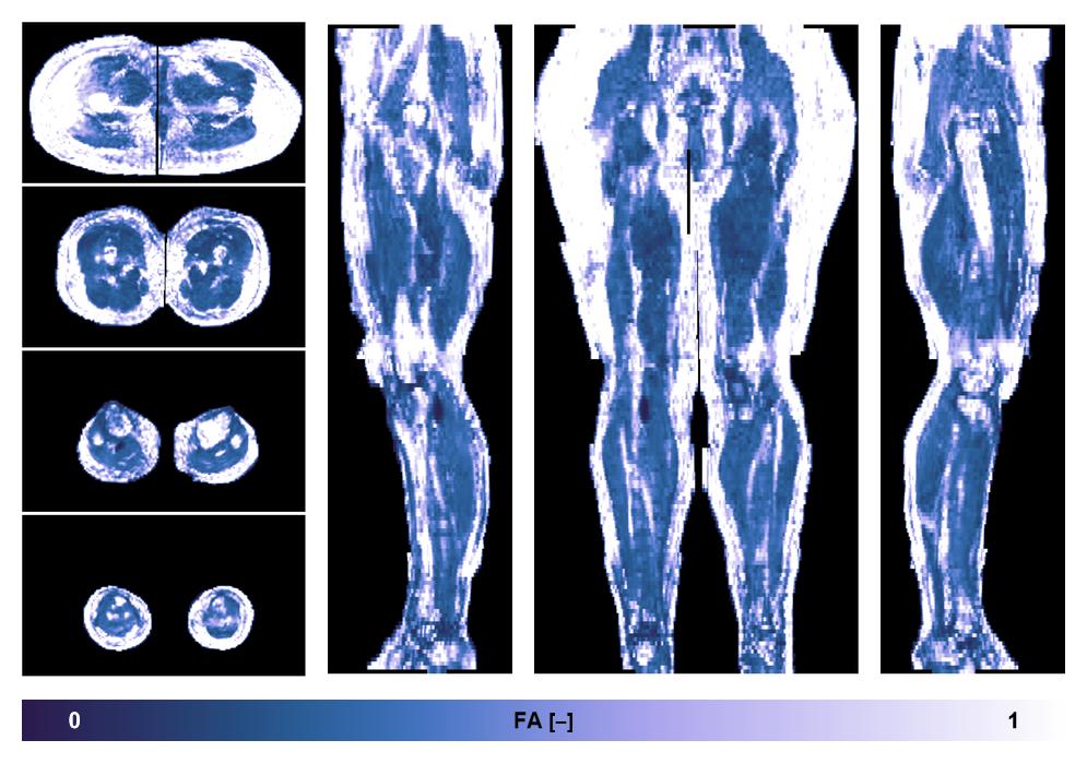 IVIM corrected whole leg muscle fractional anisotropy obtained from diffusion tensor imaging.